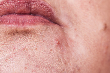 Fototapeta premium Female face with acne skin problem