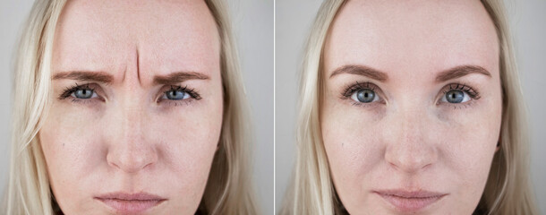 Photos before and after mesotherapy, biorevitalization, botulinum toxin injections. Skin fold between eyebrows, forehead wrinkles. At the appointment with a plastic surgeon or cosmetologist - obrazy, fototapety, plakaty