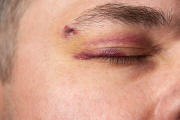 close view of a black eye, man's face with a hematoma