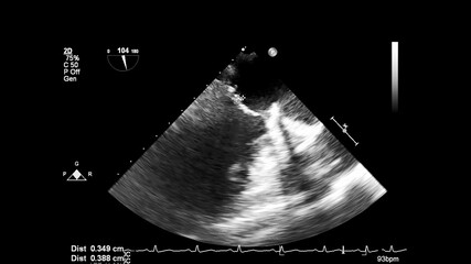 Image of the heart in gray-scale mode during transesophageal ultrasound.