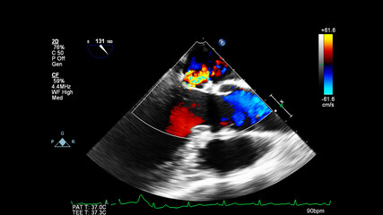 Image of the heart during transesophageal ultrasound with Doppler mode.
