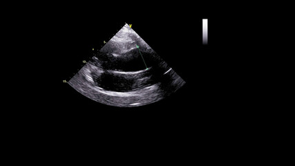Image of the heart in gray-scale mode during transesophageal ultrasound.