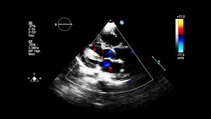 Image of the heart during transesophageal ultrasound with Doppler mode.