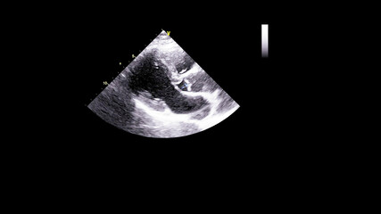 Image of the heart in gray-scale mode during transesophageal ultrasound.