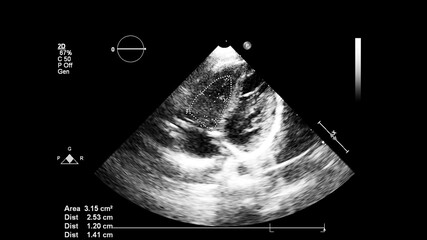 Image of the heart in gray-scale mode during transesophageal ultrasound.
