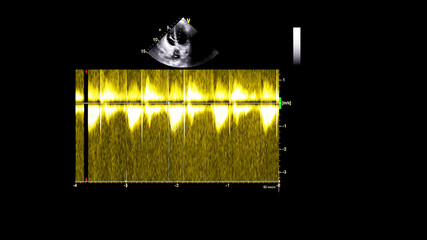Image of the heart in gray-scale mode during transesophageal ultrasound.