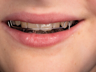 Smile mouth with open lips with wire brackets