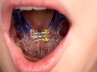 Boy wearing wire plastic jaw expander braces. Blue dental braces in children mouth.