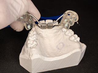 Palatal expander for the maxilla, setting test © rdonar