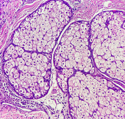 Photo of benign sebaceous glands. These glandular cells possess bland round nuclei with vacuolated...
