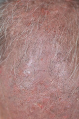 A physical of Atopic dermatitis (AD), also known as atopic eczema, is a type of inflammation of the skin (dermatitis).
