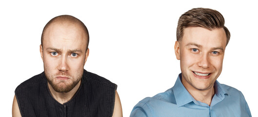 Man before and after transplant hair and alopecia. Isolated on white background