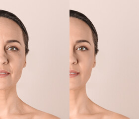 Mature woman before and after cosmetic procedure on beige background