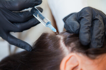 Fototapeta premium Unrecognizeble female person at trichologist office get injections in head skin. Doctor's hands holding disposable syringe under patient's head. Porcedure against hair loss and for skin health.