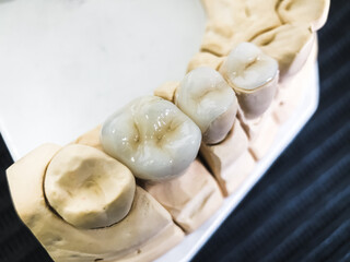 Fototapeta na wymiar Dental ceramic crowns and lining on artificial jaw. The concept of medicine and health