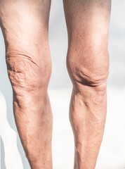 Fototapeta na wymiar Leg and knee of an old man with synovial problems on a white background
