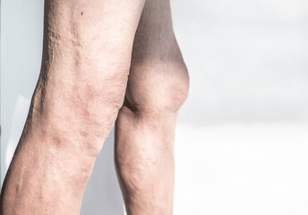 Fototapeta na wymiar Leg and knee of an old man with synovial problems on a white background