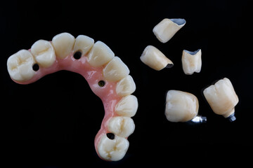 dental prosthesis of the upper jaw made of zircon with a pink gum and metal-ceramic crowns on a black background