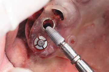 Fototapeta premium implantation through a surgical template during surgery