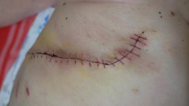 Close up of obese woman abdomen with scar and stitches after surgical operation.