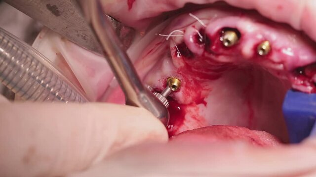 installation of dental multi-units after implantation for prosthetics of the upper jaw