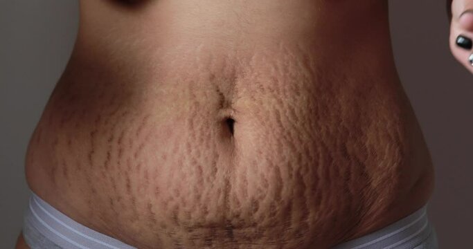 Pregnancy close up of Woman belly skin with heavy stretch wrinkle marks and loose skin after giving birth - Health care and rehabilitation for skin and body shape concept