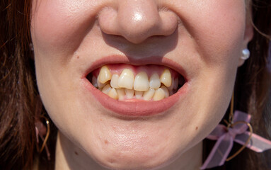 Curved female teeth, before installing braces. Close - up of teeth before treatment by an...