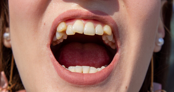 Curved female teeth, before installing braces. Close - up of teeth before treatment by an orthodontist