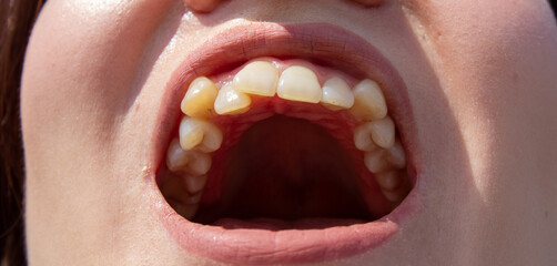 Curved female teeth, before installing braces. Close - up of teeth before treatment by an...