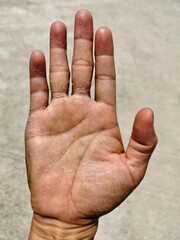 Skin peeling desquamation of hand and fingers.