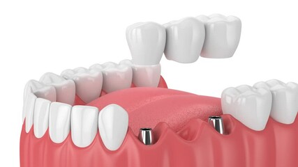 Jaw with implants supporting dental bridge over white background