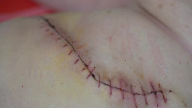 Close up of obese woman abdomen with scar and stitches after surgical operation.