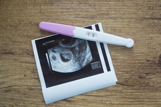 Positive pregnancy test and an ultrasound picture.