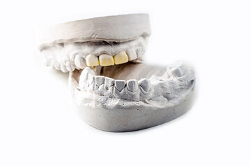 Stomatologic plaster cast, molds of human jaws and teeth on white background. Dental casting gypsum for manufacture of dentures, braces or false teeth. Dentistry and orthodontics concept. © Elena