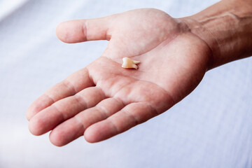 Human's tooth torn out after dentist surgery laying on the palm of the hand 