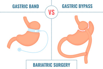 Adjustable gastric band vs gastric bypass. Bariatric surgery weight loss procedures comparison. Stomach reduction anatomical diagram infographics. Health care  medical concept. Vector illustration.