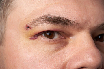 Fototapeta premium close view of a black eye, man's face with a hematoma