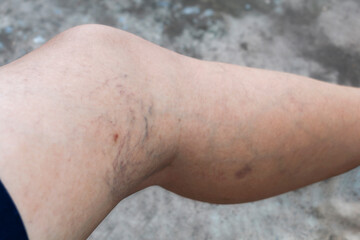 Varicose veins on female legs Vascular disease problems from active life concept.