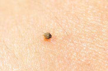 Little Ixodes ricinus bug on human skin suck blood
