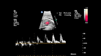 Ultrasound screen with fetal echocardiography