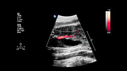 Ultrasound screen with fetal echocardiography