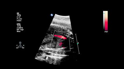 Ultrasound screen with fetal echocardiography