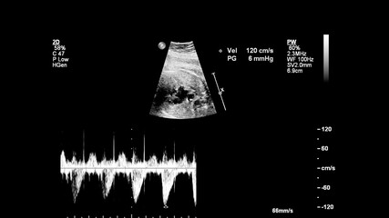 Ultrasound screen with fetal echocardiography