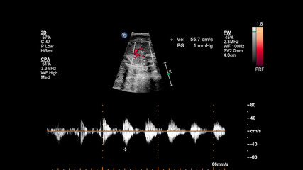 Ultrasound screen with fetal echocardiography