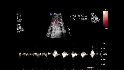 Ultrasound screen with fetal echocardiography