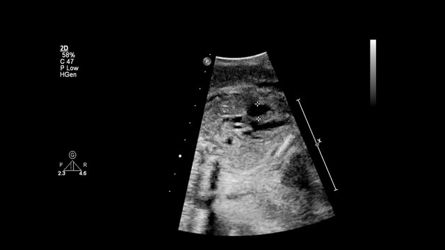 Ultrasound screen with fetal echocardiography