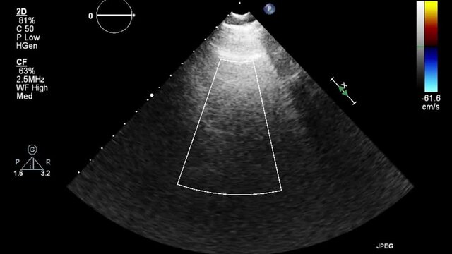 Transesophageal ultrasound video in gray-scale mode.