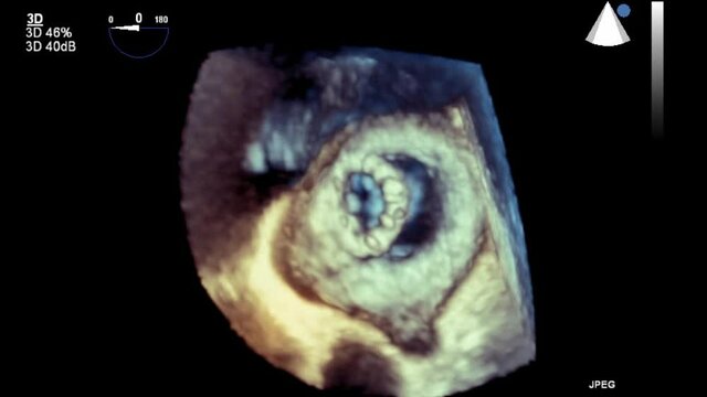 Transesophageal ultrasound video in 3D mode.
