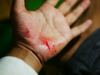Close up hand injury, accident cut with knife, real bloody hand.