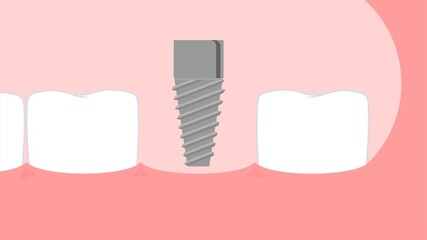 Dental implant surgery vector illustration